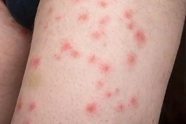 Piqûres de punaises de lit sur jambe, boutons rouges groupés caractéristiques